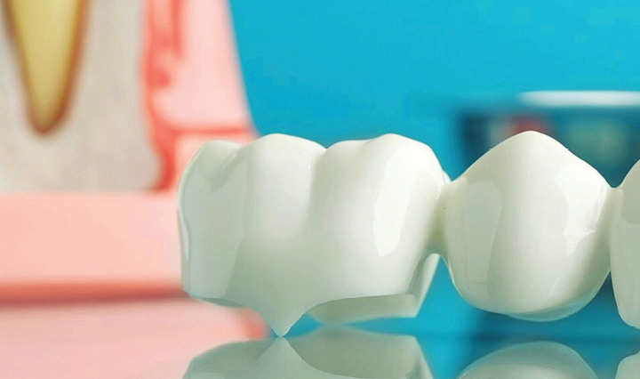 Dental Bridges