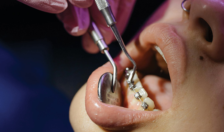 Advanced Gum Treatment